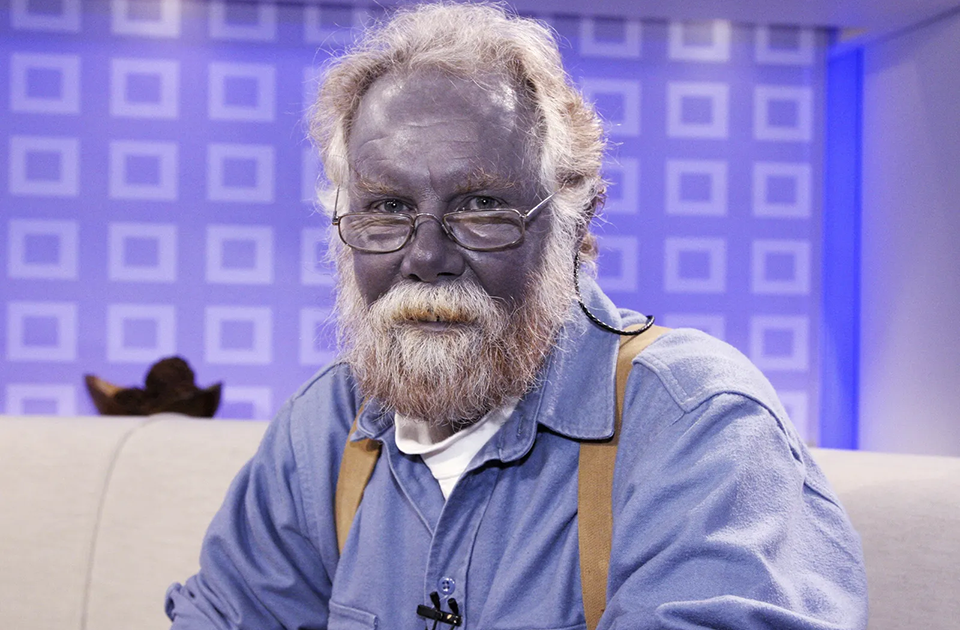 Arjiri Nedir? Arjiri (Argyria) Nedenleri ve Arjiri Tedavi Yöntemleri