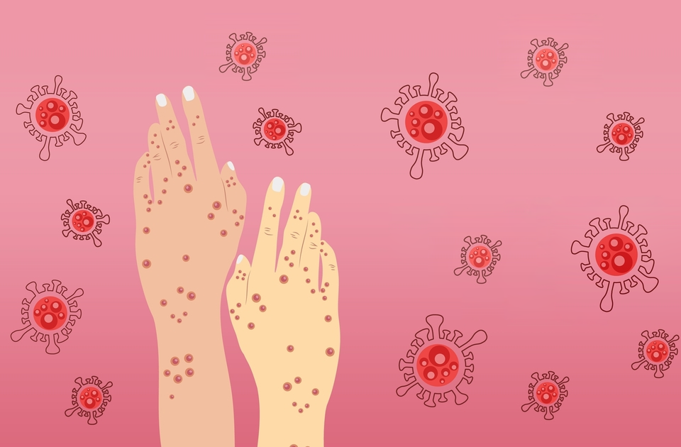 Maymun Çiçeği Virüsü Nedir? Monkeypox Belirtileri ve MCV Tedavisi